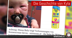 Baby trägt Verbrennungen von Sonnencreme –> kein Fake
