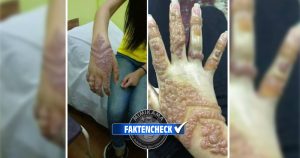 Das geht auf die Haut – Allergische Reaktion auf Henna-Tattoos