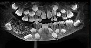 Kein Fake: Zahnärzte operieren 526 Zähne aus Mund eines 7-Jährigen