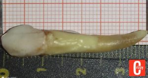 37,2 Millimeter: Das ist der größte Zahn der Welt