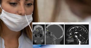 Faktencheck: „PCR-Test endet tragisch: Gehirn von Frau durchbohrt“