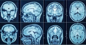 Faktencheck: Kann SARS-CoV-2 das Gehirn infizieren?