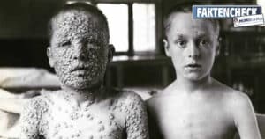 Pockenimpfung – Foto zweier Jungen, einer geimpft, der andere nicht (Faktencheck)