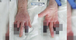 Corona-Infektion: Ärzte müssen Frau drei Finger amputieren