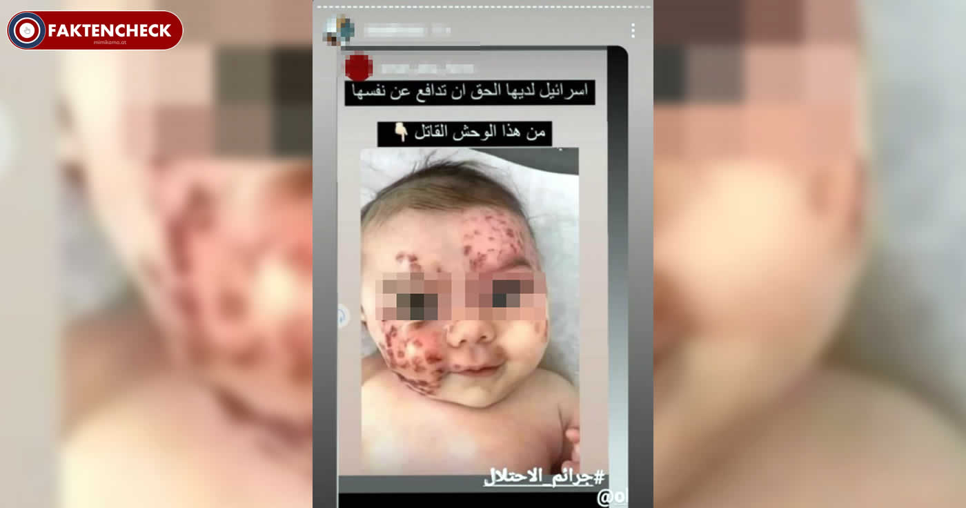 Baby mit Flecken im Gesicht: Kein Zusammenhang mit Israel-Gaza-Konflikt!